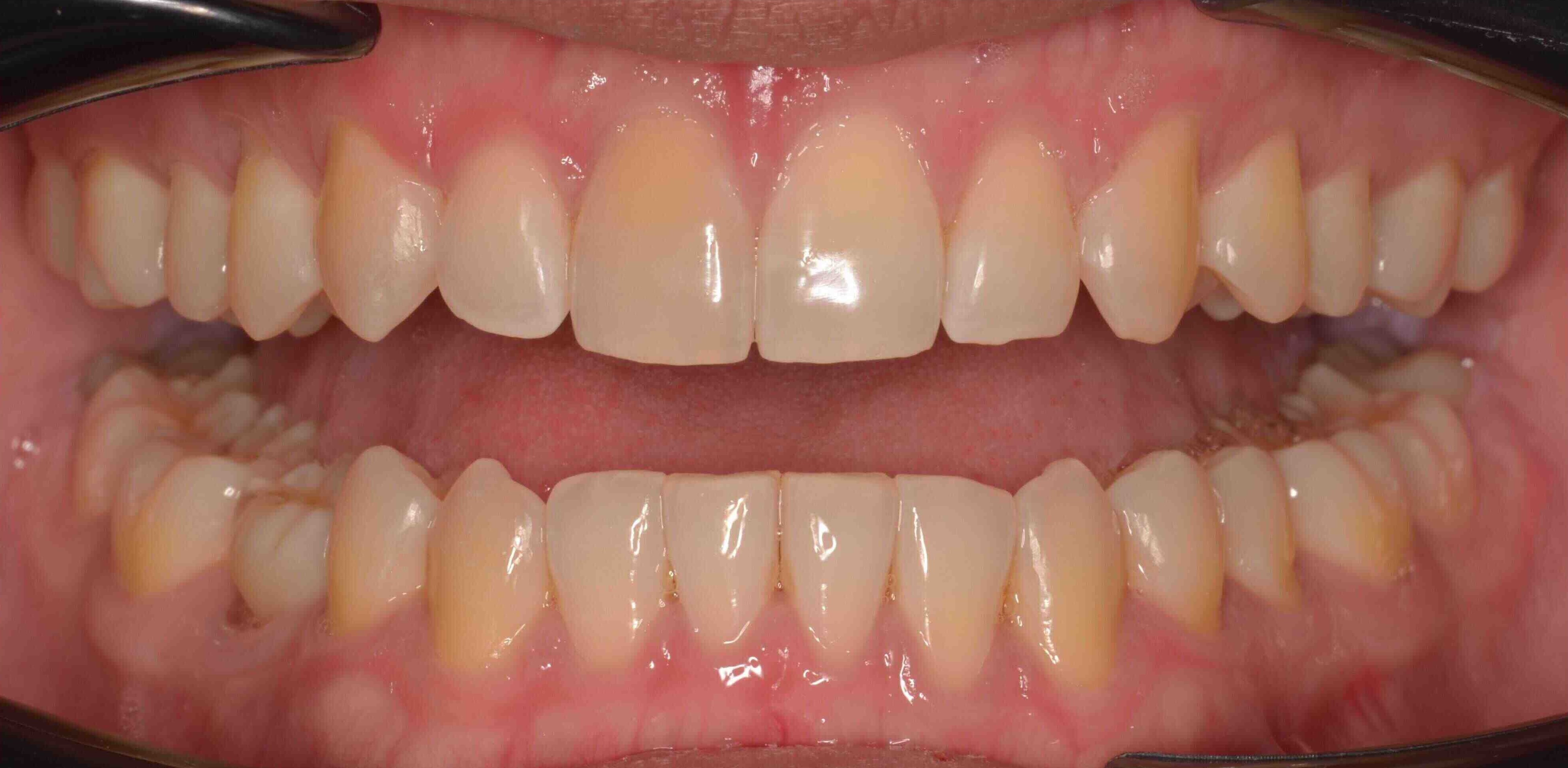 Invisalign and whitening transformation